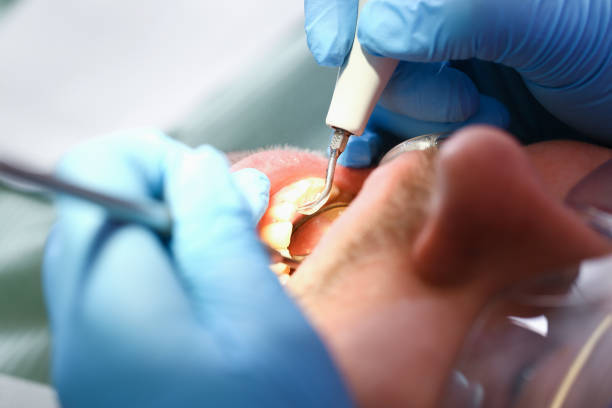 Best Emergency Wisdom Tooth Extraction in Solon, OH
